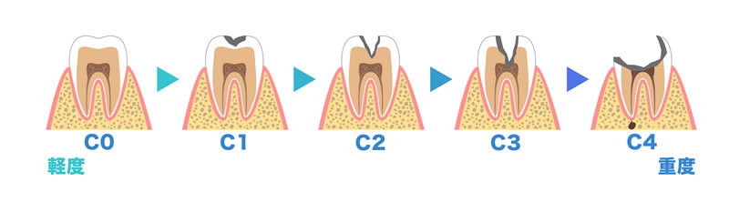 虫歯の進行
