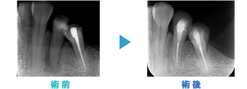 根管治療